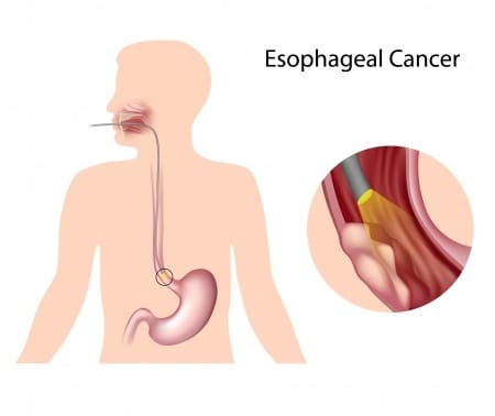 Esophageal Cancer