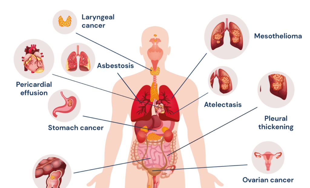 diagram of the different types of asbestos illnesses