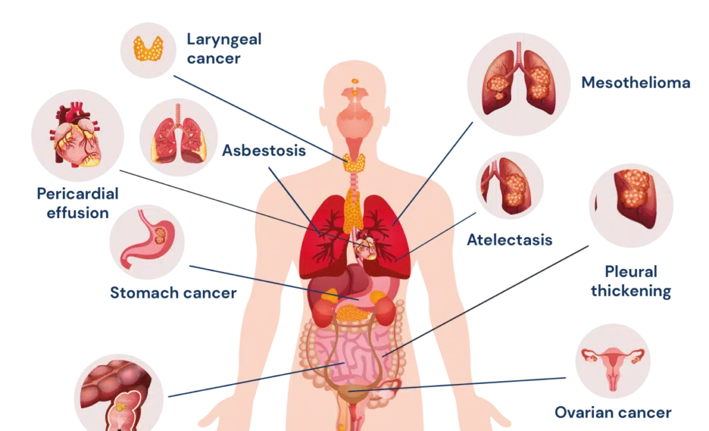 diagram of the different types of asbestos illnesses
