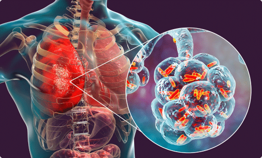 X-ray of a lung with cancerous tissue