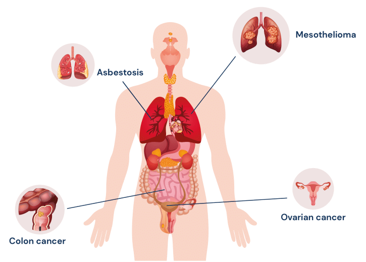 diagram depicting different asbestos related diseases