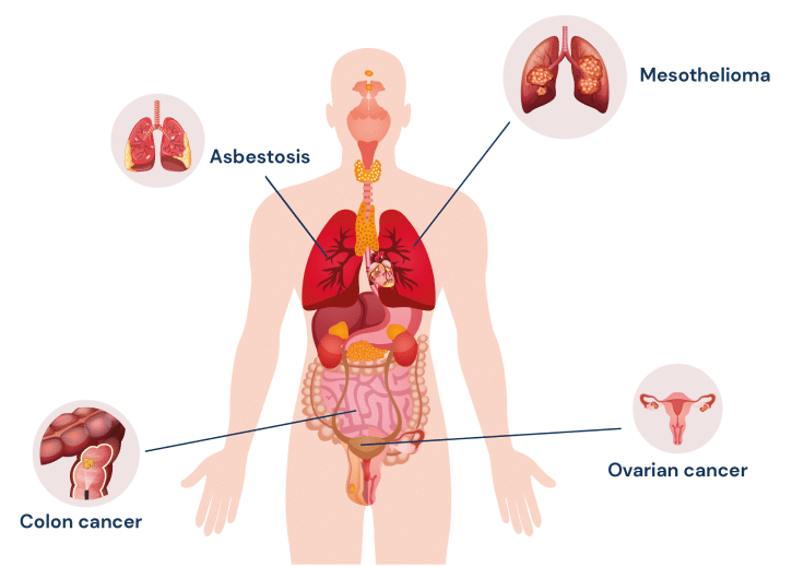 diagram depicting different asbestos related diseases