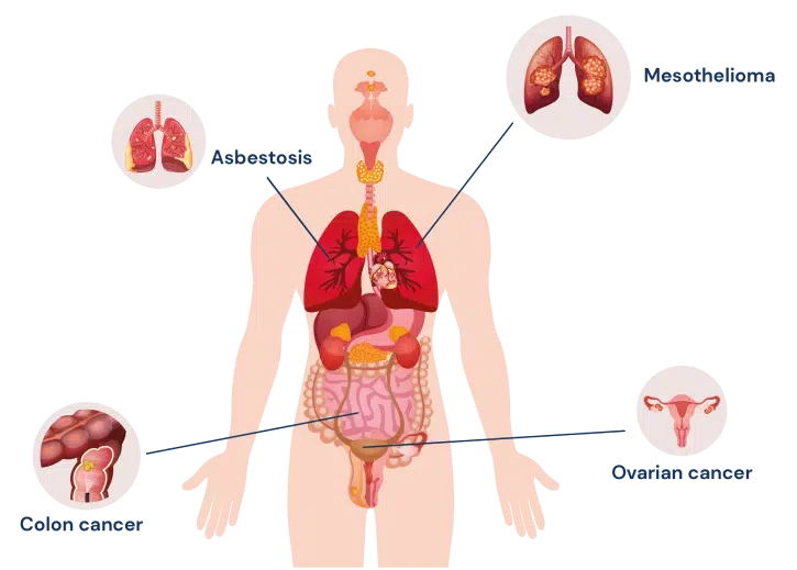 diagram depicting different asbestos related diseases