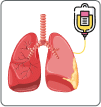 chemotherapy