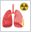 radiation therapy