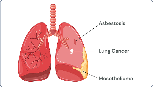 common asbestos related diseases